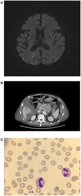 Case Report: Vaccine-Induced Immune Thrombotic Thrombocytopenia in a Pancreatic Cancer Patient After Vaccination With Messenger RNA−1273